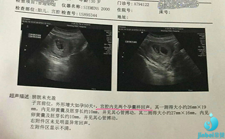 北京试管婴儿双胞胎协议书来获得你的双胞胎。(图4)